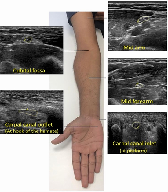  ultrasonographic correlates of carpal tunnel syndrome {faces}